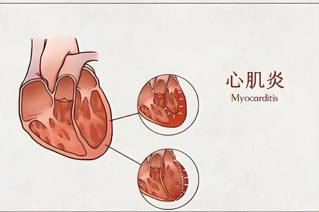 心肌炎的癥狀有哪些？心肌炎的主要變現癥狀有啥？